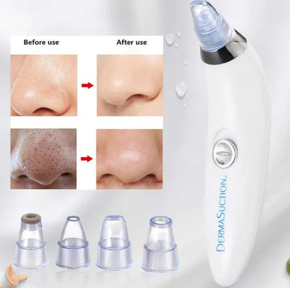 Derma Suction Pro Blackhead Remover
