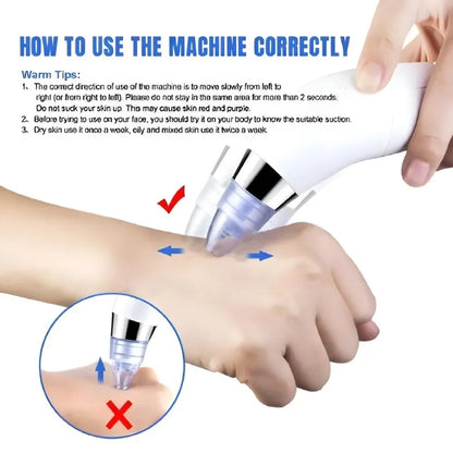 Derma Suction Pro Blackhead Remover