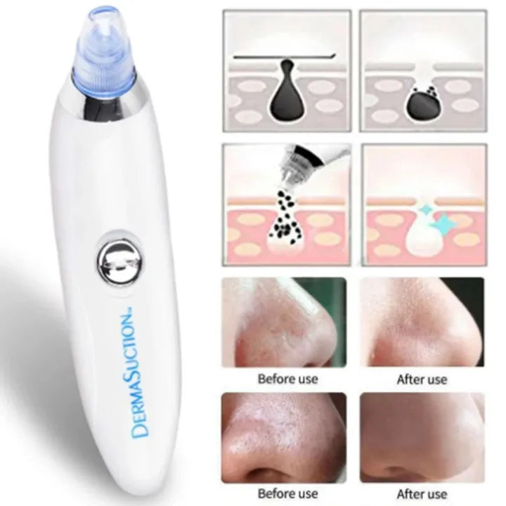 Derma Suction Pro Blackhead Remover