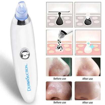 Derma Suction Pro Blackhead Remover